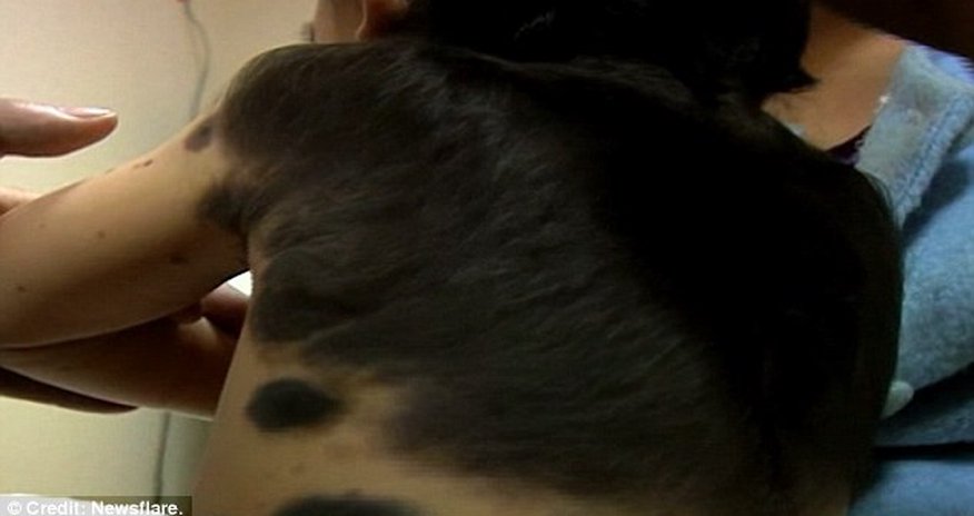 The boy with 'fur' growing on his back The boy with 'fur' growing on his back
