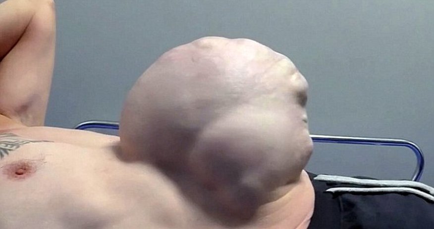 Pensioner who had hernia the size of a FOOTBALL Pensioner who had hernia the size of a FOOTBALL