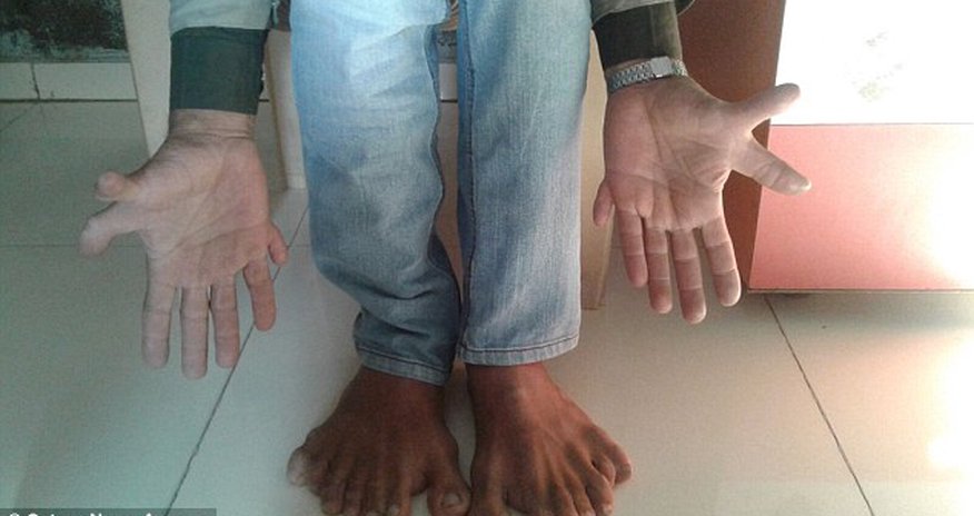 Indian carpenter with world record 28 fingers and toes