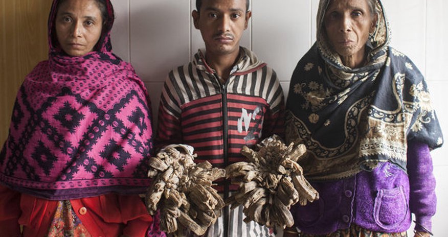 Rickshaw puller left with enormous 'erupting' hands and feet Rickshaw puller left with enormous 'erupting' hands and feet
