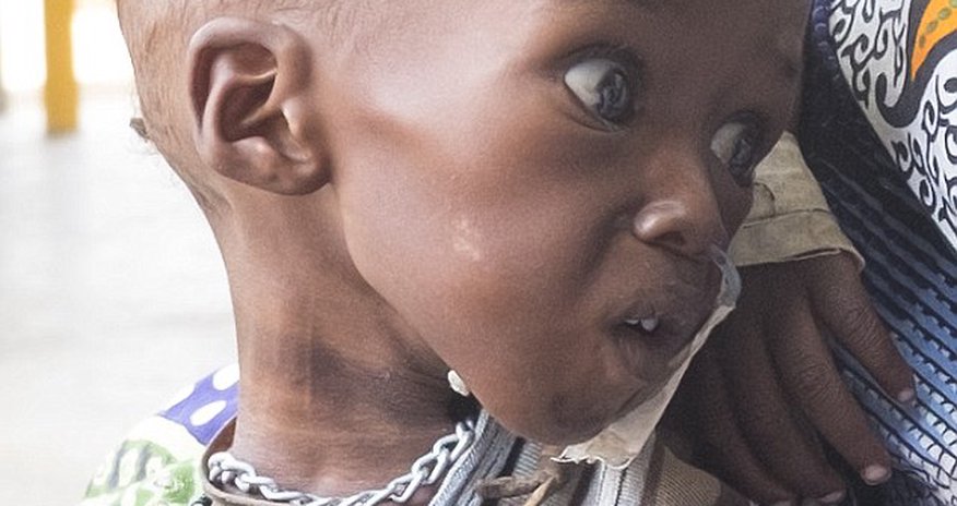 The 18-month-old toddler so ill he looks like a newborn
