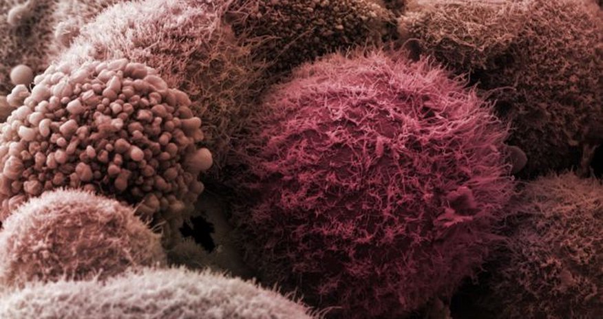 Major insight into killer pancreatic cancer Major insight into killer pancreatic cancer