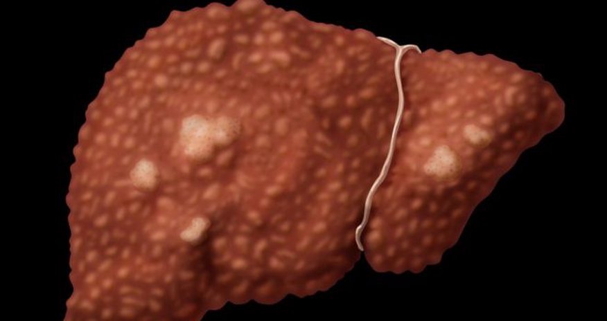 Viral hepatitis 'kills as many as Aids or TB' Viral hepatitis 'kills as many as Aids or TB'