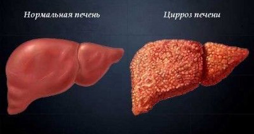 Как вылечить цирроз печени? Как вылечить цирроз печени?