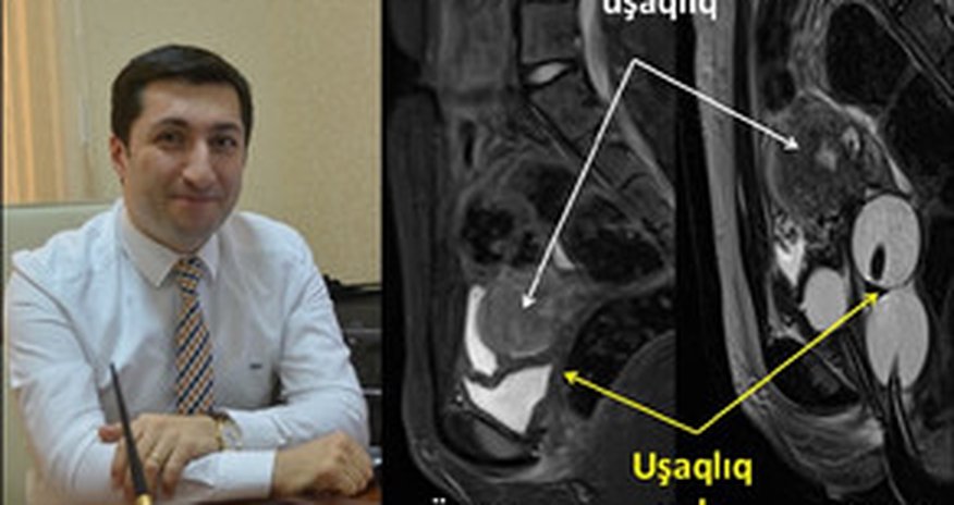 14 yaşlı qız üzərində unikal tibbi əməliyyat 14 yaşlı qız üzərində unikal tibbi əməliyyat