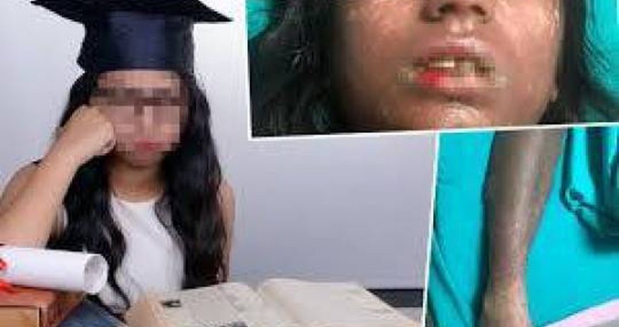 Həkimin yazdığı dərman 15 yaşlı qızcığazı bu hala gətirdi - FOTO Həkimin yazdığı dərman 15 yaşlı qızcığazı bu hala gətirdi - FOTO