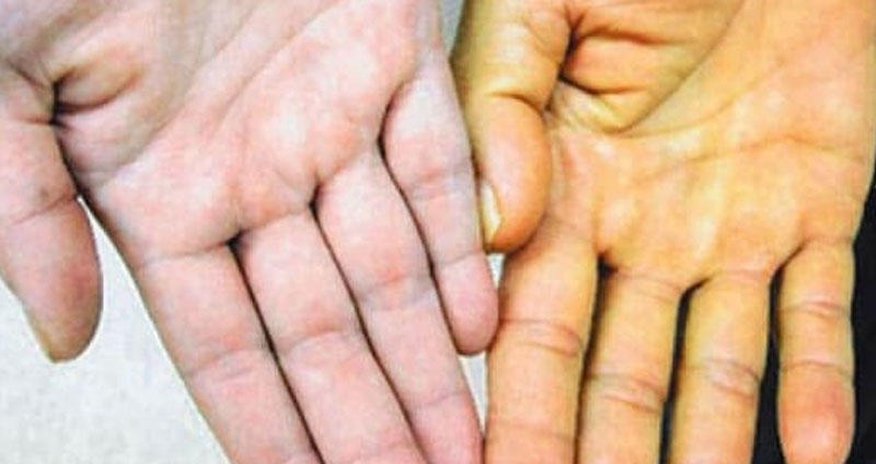 Hepatit ola biləcəyinizi göstərən 5 əlamət Hepatit ola biləcəyinizi göstərən 5 əlamət