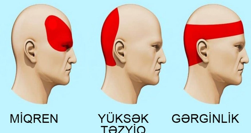 Başınız ağrıyırsa, dərman atmayın, bu çaylardan birini için Başınız ağrıyırsa, dərman atmayın, bu çaylardan birini için
