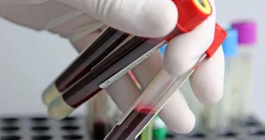 Xərçəng müayinəsində yeni qan analizi - Yaxın illərdə biopsiya olmayacaq Xərçəng müayinəsində yeni qan analizi - Yaxın illərdə biopsiya olmayacaq