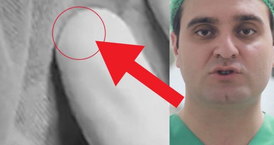 Azərbaycanda ŞOK! Həkim ikinci dəfə sünnətə gələn uşağı qıza çevirdi - VİDEO Azərbaycanda ŞOK! Həkim ikinci dəfə sünnətə gələn uşağı qıza çevirdi - VİDEO