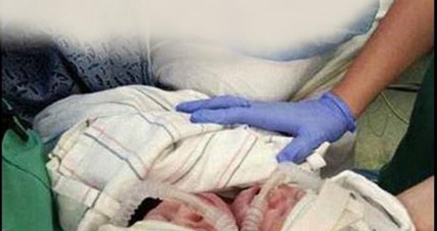 ŞOK HADİSƏ! İkibaşlı qız uşağı doğuldu ŞOK HADİSƏ! İkibaşlı qız uşağı doğuldu