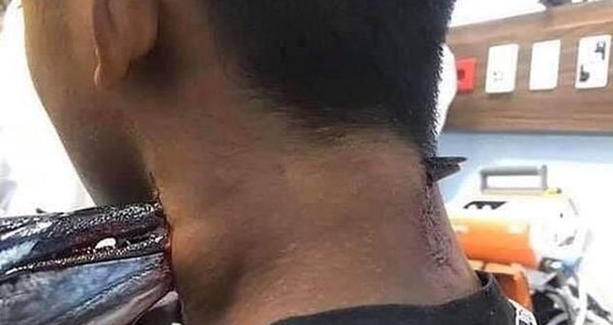 Sudan tullanan balıq oğlanın boynunu deşdi - FOTO Sudan tullanan balıq oğlanın boynunu deşdi - FOTO