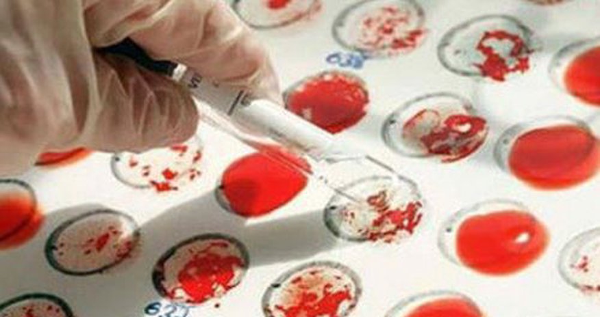 Qanın ümumi analizi onkoloji xəstəliyi göstərirmi? – Analizin asan təhlili Qanın ümumi analizi onkoloji xəstəliyi göstərirmi? – Analizin asan təhlili