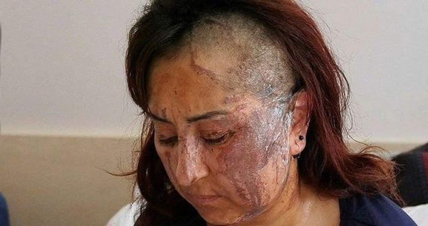 Boşanmaq istəyən arvadını belə yandırdı - FOTO Boşanmaq istəyən arvadını belə yandırdı - FOTO