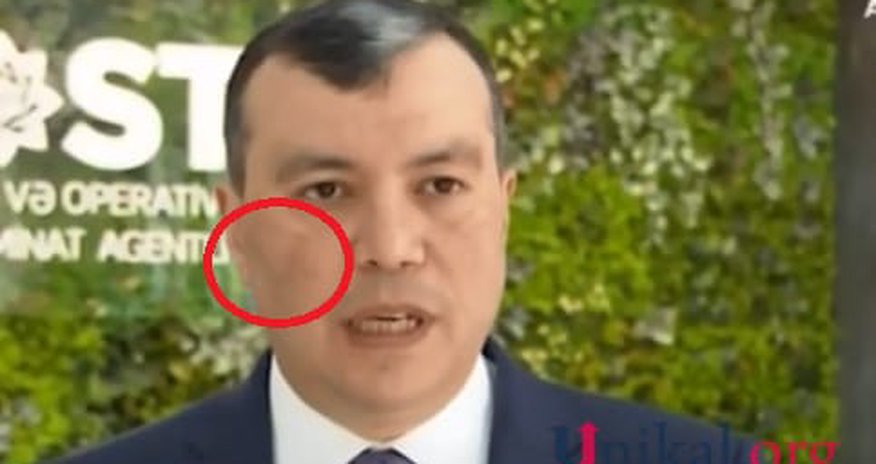 Sahil Babayevin xəstəliyinin adı bilindi — FOTO Sahil Babayevin xəstəliyinin adı bilindi — FOTO