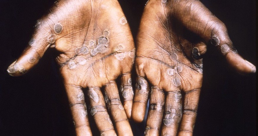 Morocco reports first monkeypox case Morocco reports first monkeypox case