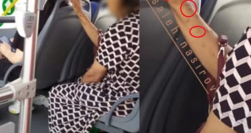 Azərbaycanda meymunçiçəyinə yoluxan şəxs var?- FOTO Azərbaycanda meymunçiçəyinə yoluxan şəxs var?- FOTO
