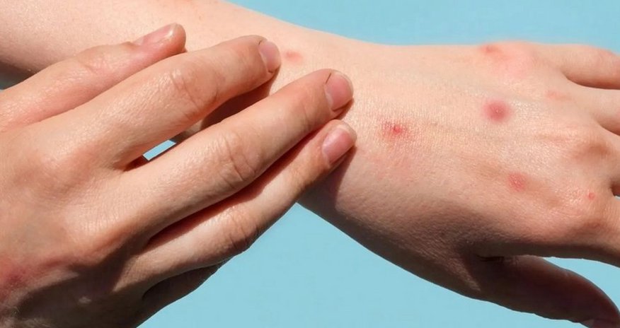 Turkiye records first case of monkeypox Turkiye records first case of monkeypox