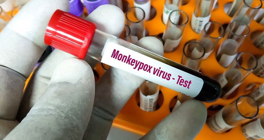 WHO provides monkeypox test kits to Azerbaijan WHO provides monkeypox test kits to Azerbaijan