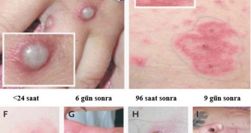 No monkeypox cases recorded in Azerbaijan - OFFICIAL No monkeypox cases recorded in Azerbaijan - OFFICIAL