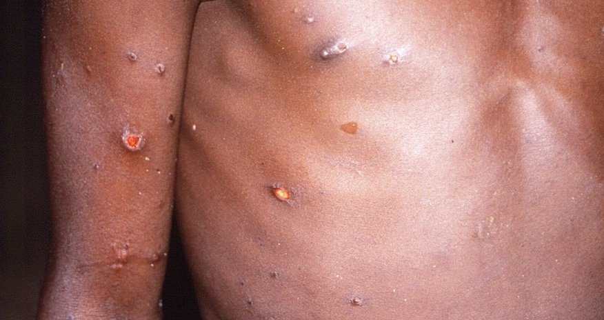 India confirms first monkeypox death India confirms first monkeypox death