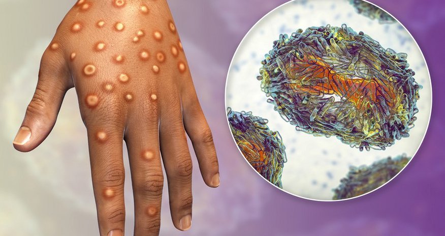 No monkeypox cases recorded in Azerbaijan No monkeypox cases recorded in Azerbaijan