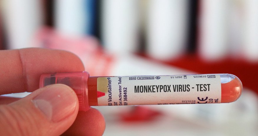 Second case of monkeypox detected in Russia Second case of monkeypox detected in Russia