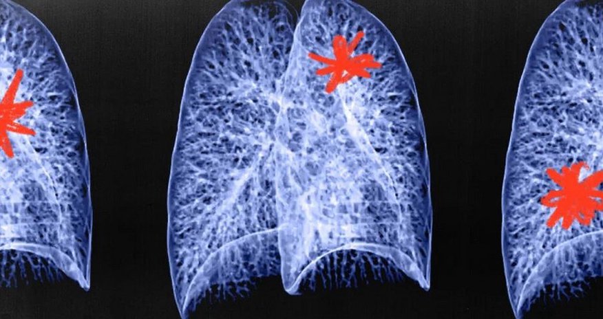 UK artificial intelligence tool can accurately identify cancer UK artificial intelligence tool can accurately identify cancer