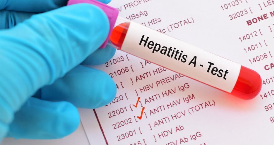 Mingəçevirdə məktəblilərdə “Hepatit A” virusu aşkarlanıb Mingəçevirdə məktəblilərdə “Hepatit A” virusu aşkarlanıb