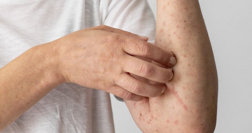 Armenia reports sharp increase in number of measles cases Armenia reports sharp increase in number of measles cases