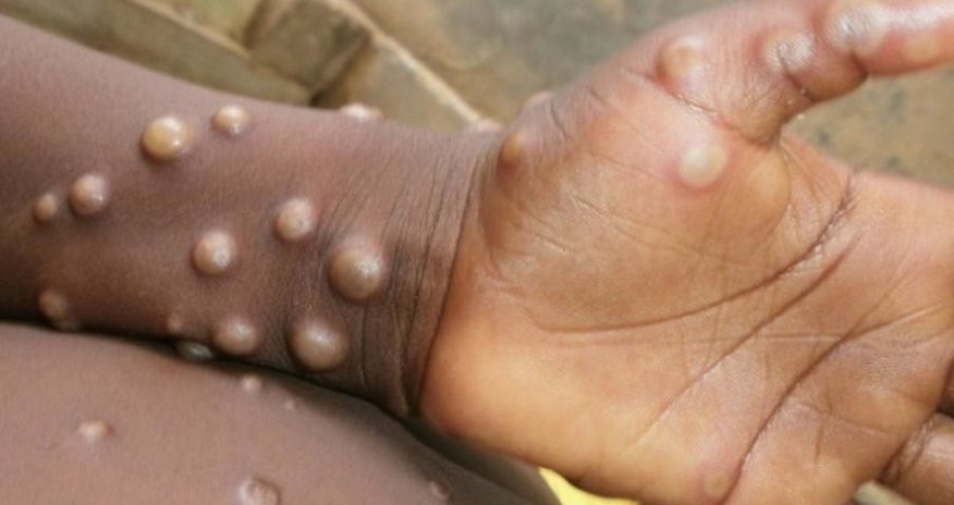 Monkeypox epidemic declared in Congo Monkeypox epidemic declared in Congo