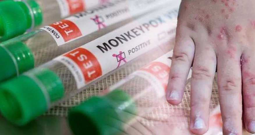 Afrikada meymunçiçəyi epidemiyası sürətlə yayılır Afrikada meymunçiçəyi epidemiyası sürətlə yayılır